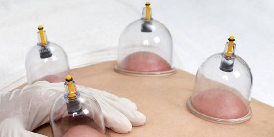 Hijama o Coppettazione - Che Cosa È?